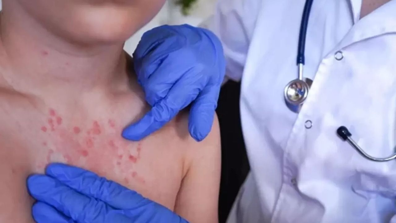 Uyuz vakaları kışın zirve yapıyor: Belirtiler 2 haftada ortaya çıkıyor, tedavi edilmezse 3 yıl sürebiliyor