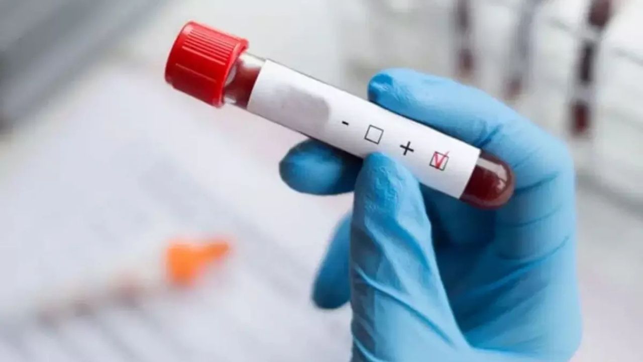 Dünya HIV Vakalarında Azalma Görürken Türkiye’de Artış Sürüyor